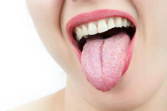 舌头中间开裂怎么回事